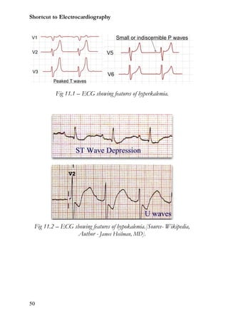 Shortcut to Electrocardiography




          Fig 11.1 – ECG showing features of hyperkalemia.




 Fig 11.2 – ECG showing features of hypokalemia.[Source- Wikipedia,
                 Author - James Heilman, MD].




50
 