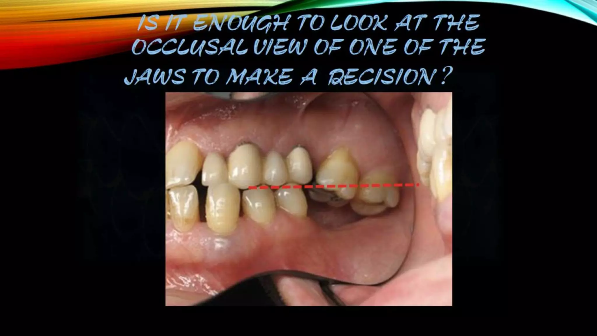Shortened dental arch sda | PPTX