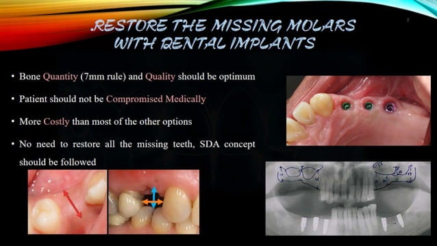 Shortened dental arch sda | PPTX