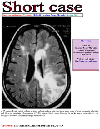 Short case publication... Version 4.1 | Edited by professor Yasser Metwally | October 2010




                                                                                                     Short case

                                                                                                     Edited by
                                                                                             Professor Yasser Metwally
                                                                                               Professor of neurology
                                                                                          Ain Shams university school of medicine
                                                                                                     Cairo, Egypt

                                                                                                Visit my web site at:
                                                                                             http://yassermetwally.com




A 65 years old male patient suffered an acute ischemic embolic infarction in the acute stage of acute myocardial infarction
and following an episode of paroxysmal AF. The patient clinical course following the stroke was an uneventful on even
though the infarction showed hemorragic transformation.




DIAGNOSIS: HEMORRHAGIC ARTERIAL EMBOLIC INFARCTION
 