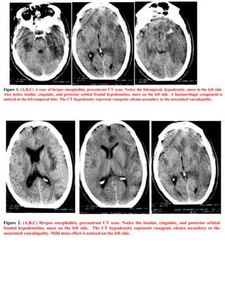 Figure 1. (A,B,C) A case of herpes encephalitis, precontrast CT scan. Notice the bitemporal, hypodensity, more in the left side.
Also notice insular, cingulate, and posterior orbital frontal hypodensities, more on the left side. A haemorrhagic component is
noticed at the left temporal lobe. The CT hypodensity represent vasogenic edema secondary to the associated vasculopathy.




Figure 2. (A,B,C) Herpes encephalitis, precontrast CT scan. Notice the insular, cingulate, and posterior orbital
frontal hypodensities, more on the left side. The CT hypodensity represent vasogenic edema secondary to the
associated vasculopathy. Mild mass effect is noticed on the left side.
 