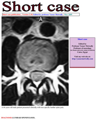 Short case publication... Version 2.18| Edited by professor Yasser Metwally | May 2009




                                                                                                   Short case

                                                                                                  Edited by
                                                                                          Professor Yasser Metwally
                                                                                            Professor of neurology
                                                                                        Ain Shams university school of medicine
                                                                                                   Cairo, Egypt

                                                                                             Visit my web site at:
                                                                                          http://yassermetwally.com




A 66 years old male patient presented clinically with non specific lumbar spine pain.




DIAGNOSIS:LUMBAR SPONDYLOSIS.
 
