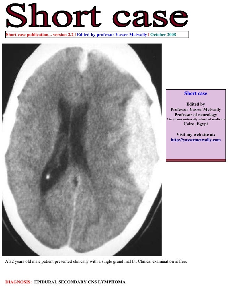 Short case...Epidural secondary CNS lymphoma