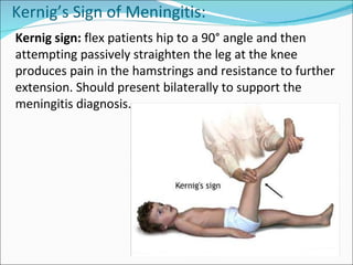 Kernig’s Sign of Meningitis: Kernig sign:  flex patients hip to a 90° angle and then attempting passively straighten the leg at the knee produces pain in the hamstrings and resistance to further extension. Should present bilaterally to support the meningitis diagnosis. 