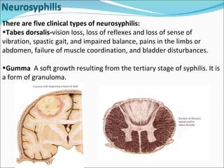 There are five clinical types of neurosyphilis: Tabes dorsalis- vision loss, loss of reflexes and loss of sense of vibration, spastic gait, and impaired balance, pains in the limbs or abdomen, failure of muscle coordination, and bladder disturbances.  Gumma  A soft growth resulting from the tertiary stage of syphilis. It is a form of granuloma. 