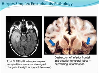 Axial FLAIR MRI in herpes simplex encephalitis shows extensive signal change in the right temporal lobe (arrow). Destruction of inferior frontal and anterior temporal lobes – necrotizing inflammation 