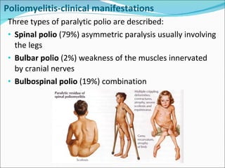 Poliomyelitis-clinical manifestations Three types of paralytic polio are described: Spinal polio  (79%) asymmetric paralysis usually involving the legs Bulbar polio  (2%) weakness of the muscles innervated by cranial nerves Bulbospinal polio  (19%) combination 