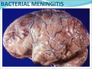 BACTERIAL MENINGITIS 