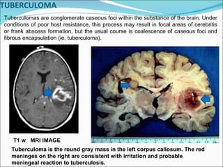 TUBERCULOMA T1 w  MRI IMAGE Tuberculoma is the round gray mass in the left corpus callosum. The red meninges on the right are consistent with irritation and probable meningeal reaction to tuberculosis. Tuberculomas are conglomerate caseous foci within the substance of the brain. Under conditions of poor host resistance, this process may result in focal areas of cerebritis or frank abscess formation, but the usual course is coalescence of caseous foci and fibrous encapsulation (ie, tuberculoma).  