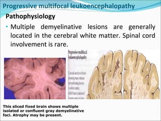 Progressive multifocal leukoencephalopathy  Pathophysiology  Multiple demyelinative lesions are generally located in the cerebral white matter. Spinal cord involvement is rare. This sliced fixed brain shows multiple isolated or confluent gray demyelinative foci. Atrophy may be present.  