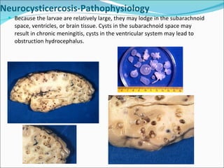 Because the larvae are relatively large, they may lodge in the subarachnoid space, ventricles, or brain tissue. Cysts in the subarachnoid space may result in chronic meningitis, cysts in the ventricular system may lead to obstruction hydrocephalus. Neurocysticercosis-Pathophysiology 