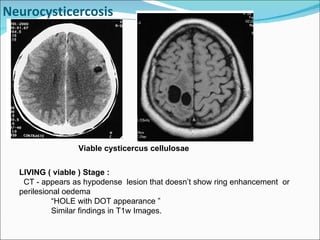 Neurocysticercosis Viable cysticercus cellulosae  LIVING ( viable ) Stage :  CT - appears as hypodense  lesion that doesn’t show ring enhancement  or perilesional oedema “ HOLE with DOT appearance ” Similar findings in T1w Images. 