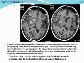 T1-weighted axial gadolinium-enhanced magnetic resonance images at 2 levels through the basal ganglia (same patient as in the previous image). These images show 2 complex, ring-enhancing lesions in the basal ganglia on the right, with surrounding notable white matter edema. This appearance is typical of central nervous system toxoplasmosis, which has the propensity for involvement of the basal ganglia. Toxoplasmosis T1-MRI multiple contrast enhancing  necrotic focal lesions with predispostion to the basal ganglia and subcortical region. 