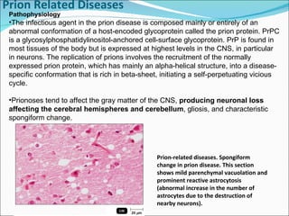 Prion Related Diseases     Pathophysiology  The infectious agent in the prion disease is composed mainly or entirely of an abnormal conformation of a host-encoded glycoprotein called the prion protein. PrPC is a glycosylphosphatidylinositol-anchored cell-surface glycoprotein. PrP is found in most tissues of the body but is expressed at highest levels in the CNS, in particular in neurons. The replication of prions involves the recruitment of the normally expressed prion protein, which has mainly an alpha-helical structure, into a disease-specific conformation that is rich in beta-sheet, initiating a self-perpetuating vicious cycle.  Prionoses tend to affect the gray matter of the CNS,  producing neuronal loss affecting the cerebral hemispheres and cerebellum , gliosis, and characteristic spongiform change.  Prion-related diseases. Spongiform change in prion disease. This section shows mild parenchymal vacuolation and prominent reactive astrocytosis (abnormal increase in the number of astrocytes due to the destruction of nearby neurons). 