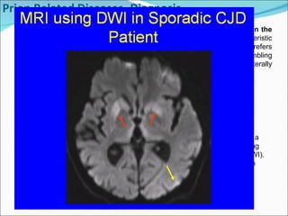 Prion Related Diseases -Diagnosis Imaging Studies MRI is an important imaging test. MRI may show  hyperintense signals in the cortical ribbon, basal ganglia, and the thalamus  Two characteristic radiological signs have been described.  The "hockey stick" sign , which refers to increased signal in the putamen and head of the caudate nucleus resembling a hockey stick, and the "pulvinar" sign, which corresponds to a usually bilaterally increased signal in the pulvinar thalamic nuclei.  Shows characteristic signal changes of an MRI taken from a patient with sporadic CJD, using diffusion-weighted imaging (DWI). An abnormal signal is shown in both the basal ganglia (red arrows) and the cortical ribbon (yellow arrow). 