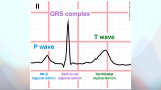 Short QT syndrome. Description, Evaluation, ECG changes. | PDF