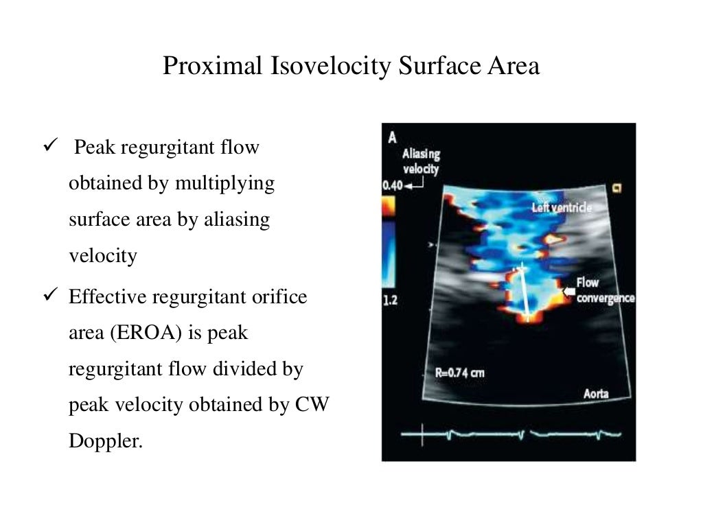 Echocardiography Assessment Of Aortic Regurgitation Severity echocardiography-assessment-of-aortic-regurgitation-severity