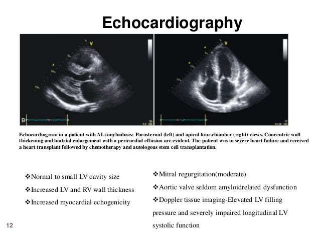 normal lv dimensions echo Short review cardiac amyloidosis and recent advances