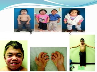 Approach to Short Stature in children .pptx