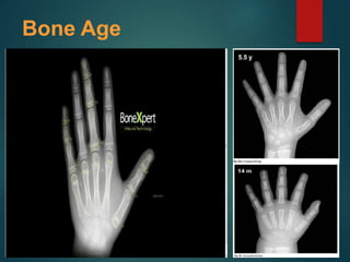 Bone Age
 