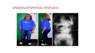 SPONDYLOEPIPHYSEAL DYSPLASIA
 