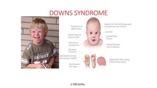 DOWNS SYNDROME
1:700 births
 
