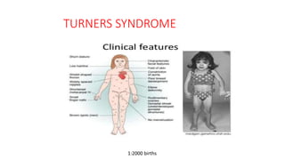 TURNERS SYNDROME
1:2000 births
 