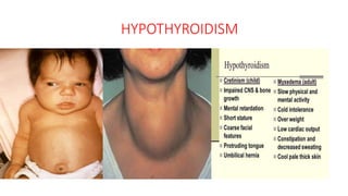 HYPOTHYROIDISM
 