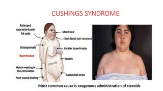 CUSHINGS SYNDROME
Most common cause is exogenous administration of steroids
 