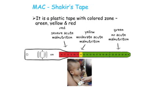 MAC - Shakir’s Tape
It is a plastic tape with colored zone –
green, yellow & red
eindicateseverema12.5cm
Yellow indicates moderate malnutrition
(12.5-13.5cm)
reendica13.5cm
 