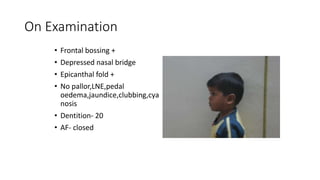 On Examination
• Frontal bossing +
• Depressed nasal bridge
• Epicanthal fold +
• No pallor,LNE,pedal
oedema,jaundice,clubbing,cya
nosis
• Dentition- 20
• AF- closed
 