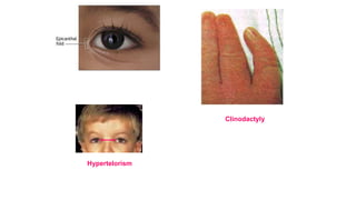 Hypertelorism
Clinodactyly
 