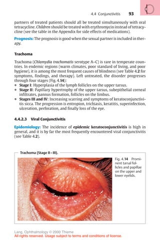 93
Trachoma (Stage II–III).
Fig. 4.14 Promi-
nent tarsal fol-
licles and papillae
on the upper and
lower eyelids.
partners of treated patients should all be treated simultaneously with oral
tetracycline. Children should be treated with erythromycin instead of tetracy-
cline (see the table in the Appendix for side effects of medications).
Prognosis: The prognosis is good when the sexual partner is included in ther-
apy.
Trachoma
Trachoma (Chlamydia trachomatis serotype A–C) is rare in temperate coun-
tries. In endemic regions (warm climates, poor standard of living, and poor
hygiene), it is among the most frequent causes of blindness (see Table 4.2 for
symptoms, findings, and therapy). Left untreated, the disorder progresses
through four stages (Fig. 4.14):
❖ Stage I: Hyperplasia of the lymph follicles on the upper tarsus.
❖ Stage II: Papillary hypertrophy of the upper tarsus, subepithelial corneal
infiltrates, pannus formation, follicles on the limbus.
❖ Stages III and IV: Increasing scarring and symptoms of keratoconjunctivi-
tis sicca. The progression is entropion, trichiasis, keratitis, superinfection,
ulceration, perforation, and finally loss of the eye.
4.4.2.3 Viral Conjunctivitis
Epidemiology: The incidence of epidemic keratoconjunctivitis is high in
general, and it is by far the most frequently encountered viral conjunctivitis
(see Table 4.2).
4.4 Conjunctivitis
Lang, Ophthalmology © 2000 Thieme
All rights reserved. Usage subject to terms and conditions of license.
 