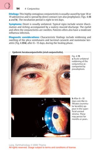 94
Etiology: This highly contagious conjunctivitis is usually caused by type 18 or
19 adenovirus and is spread by direct contact (see also prophylaxis; Figs. 4.15
a and b). The incubation period is eight to ten days.
Symptoms: Onset is usually unilateral. Typical signs include severe illacri-
mation and itching accompanied by a watery mucoid discharge. The eyelid
and often the conjunctivitis are swollen. Patients often also have a moderate
influenza infection.
Diagnostic considerations: Characteristic findings include reddening and
swelling of the plica semilunaris and lacrimal caruncle and nummular ker-
atitis (Fig. 4.15b) after 8–15 days, during the healing phase.
Epidemic keratoconjunctivitis (viral conjunctivitis).
Fig. 4.15
a Acute unilateral
reddening of the
conjunctiva ac-
companied by
pseudoptosis.
b After 8–10
days coin-like in-
filtrates (nummu-
lar keratitis) ap-
pear in the super-
ficial corneal
stroma. These
may persist for
months or years.
4 Conjunctiva
Lang, Ophthalmology © 2000 Thieme
All rights reserved. Usage subject to terms and conditions of license.
 