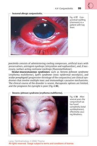 99
junctivitis consists of administering cooling compresses, artificial tears with
preservatives, astringent eyedrops (tetryzoline and naphazoline), and, if nec-
essary, surface-acting cortisone eyedrops (fluorometholone).
Ocular-mucocutaneous syndromes such as Stevens–Johnson syndrome
(erythema multiforme), Lyell’s syndrome (toxic epidermal necrolysis), and
ocular pemphigoid (progressive shrinkage of the conjunctiva) are clinical syn-
dromes that involve multiple toxic and immunologic causative mechanisms.
The clinical course of the disorder is severe, therapeutic options are limited,
and the prognosis for eyesight is poor (Fig. 4.18).
Seasonal allergic conjunctivitis.
Fig. 4.17 Con-
junctival swelling
(chemosis) in a
patient with hay
fever.
Stevens–Johnson syndrome (erythema multiforme).
Fig. 4.18 After
several years the
conjunctival sac
has fused
completely (total
symblepharon),
effectively caus-
ing blindness.
4.4 Conjunctivitis
Lang, Ophthalmology © 2000 Thieme
All rights reserved. Usage subject to terms and conditions of license.
 
