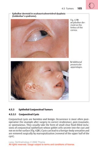 105
Epibulbar dermoid in oculoauriculovertebral dysplasia
(Goldenhar’s syndrome).
Fig. 4.19
a Epibulbar der-
moid on the
limbus of the
cornea.
b Additional
preauricular
appendages.
4.5.3 Epithelial Conjunctival Tumors
4.5.3.1 Conjunctival Cysts
Conjunctival cysts are harmless and benign. Occurrence is most often post-
operative (for example after surgery to correct strabismus), post-traumatic,
or spontaneous. They usually take the form of small clear fluid-filled inclu-
sions of conjunctival epithelium whose goblet cells secrete into the cyst and
not on to the surface (Fig. 4.21). Cysts can lead to a foreign-body sensation and
are removed surgically by marsupialization (removal of the upper half of the
cyst).
4.5 Tumors
Lang, Ophthalmology © 2000 Thieme
All rights reserved. Usage subject to terms and conditions of license.
 