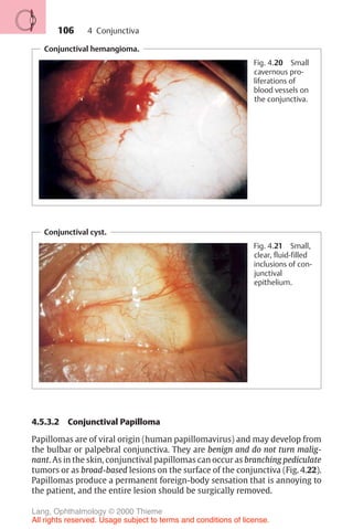 106
Conjunctival hemangioma.
Fig. 4.20 Small
cavernous pro-
liferations of
blood vessels on
the conjunctiva.
Conjunctival cyst.
Fig. 4.21 Small,
clear, fluid-filled
inclusions of con-
junctival
epithelium.
4.5.3.2 Conjunctival Papilloma
Papillomas are of viral origin (human papillomavirus) and may develop from
the bulbar or palpebral conjunctiva. They are benign and do not turn malig-
nant. As in the skin, conjunctival papillomas can occur as branching pediculate
tumors or as broad-based lesions on the surface of the conjunctiva (Fig. 4.22).
Papillomas produce a permanent foreign-body sensation that is annoying to
the patient, and the entire lesion should be surgically removed.
4 Conjunctiva
Lang, Ophthalmology © 2000 Thieme
All rights reserved. Usage subject to terms and conditions of license.
 