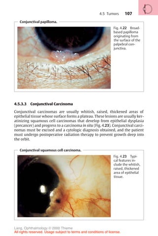 107
Conjunctival papilloma.
Fig. 4.22 Broad-
based papilloma
originating from
the surface of the
palpebral con-
junctiva.
4.5.3.3 Conjunctival Carcinoma
Conjunctival carcinomas are usually whitish, raised, thickened areas of
epithelial tissue whose surface forms a plateau. These lesions are usually ker-
atinizing squamous cell carcinomas that develop from epithelial dysplasia
(precancer) and progress to a carcinoma in situ (Fig. 4.23). Conjunctival carci-
nomas must be excised and a cytologic diagnosis obtained, and the patient
must undergo postoperative radiation therapy to prevent growth deep into
the orbit.
Conjunctival squamous cell carcinoma.
Fig. 4.23 Typi-
cal features in-
clude the whitish,
raised, thickened
area of epithelial
tissue.
4.5 Tumors
Lang, Ophthalmology © 2000 Thieme
All rights reserved. Usage subject to terms and conditions of license.
 