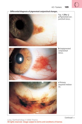 109
Differential diagnosis of pigmented conjunctival changes.
Figs. 4.24a–j
a Pigmented con-
junctival nevus.
b Unpigmented
conjunctival
nevus.
c Primary
acquired melano-
sis.
Continued !
4.5 Tumors
Lang, Ophthalmology © 2000 Thieme
All rights reserved. Usage subject to terms and conditions of license.
 