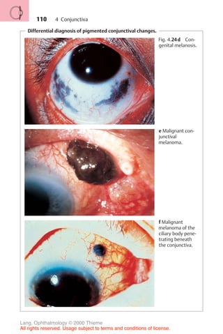 110
Differential diagnosis of pigmented conjunctival changes.
Fig. 4.24d Con-
genital melanosis.
e Malignant con-
junctival
melanoma.
f Malignant
melanoma of the
ciliary body pene-
trating beneath
the conjunctiva.
4 Conjunctiva
Lang, Ophthalmology © 2000 Thieme
All rights reserved. Usage subject to terms and conditions of license.
 