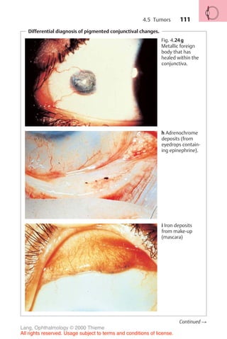 111
Differential diagnosis of pigmented conjunctival changes.
Fig. 4.24g
Metallic foreign
body that has
healed within the
conjunctiva.
h Adrenochrome
deposits (from
eyedrops contain-
ing epinephrine).
i Iron deposits
from make-up
(mascara)
Continued !
4.5 Tumors
Lang, Ophthalmology © 2000 Thieme
All rights reserved. Usage subject to terms and conditions of license.
 