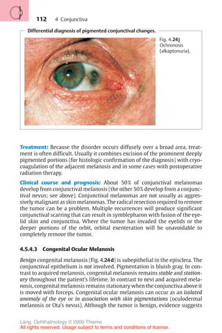 112
Differential diagnosis of pigmented conjunctival changes.
Fig. 4.24j
Ochronosis
(alkaptonuria).
Treatment: Because the disorder occurs diffusely over a broad area, treat-
ment is often difficult. Usually it combines excision of the prominent deeply
pigmented portions (for histologic confirmation of the diagnosis) with cryo-
coagulation of the adjacent melanosis and in some cases with postoperative
radiation therapy.
Clinical course and prognosis: About 50% of conjunctival melanomas
develop from conjunctival melanosis (the other 50% develop from a conjunc-
tival nevus; see above). Conjunctival melanomas are not usually as aggres-
sively malignant as skin melanomas. The radical resection required to remove
the tumor can be a problem. Multiple recurrences will produce significant
conjunctival scarring that can result in symblepharon with fusion of the eye-
lid skin and conjunctiva. Where the tumor has invaded the eyelids or the
deeper portions of the orbit, orbital exenteration will be unavoidable to
completely remove the tumor.
4.5.4.3 Congenital Ocular Melanosis
Benign congenital melanosis (Fig. 4.24d) is subepithelial in the episclera. The
conjunctival epithelium is not involved. Pigmentation is bluish gray. In con-
trast to acquired melanosis, congenital melanosis remains stable and station-
ary throughout the patient’s lifetime. In contrast to nevi and acquired mela-
nosis, congenital melanosis remains stationary when the conjunctiva above it
is moved with forceps. Congenital ocular melanosis can occur as an isolated
anomaly of the eye or in association with skin pigmentations (oculodermal
melanosis or Ota’s nevus). Although the tumor is benign, evidence suggests
4 Conjunctiva
Lang, Ophthalmology © 2000 Thieme
All rights reserved. Usage subject to terms and conditions of license.
 