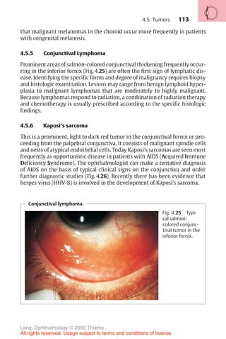 113
that malignant melanomas in the choroid occur more frequently in patients
with congenital melanosis.
4.5.5 Conjunctival Lymphoma
Prominent areas of salmon-colored conjunctival thickening frequently occur-
ring in the inferior fornix (Fig. 4.25) are often the first sign of lymphatic dis-
ease. Identifying the specific forms and degree of malignancy requires biopsy
and histologic examination. Lesions may range from benign lymphoid hyper-
plasia to malignant lymphomas that are moderately to highly malignant.
Because lymphomas respond to radiation, a combination of radiation therapy
and chemotherapy is usually prescribed according to the specific histologic
findings.
4.5.6 Kaposi’s sarcoma
This is a prominent, light to dark red tumor in the conjunctival fornix or pro-
ceeding from the palpebral conjunctiva. It consists of malignant spindle cells
and nests of atypical endothelial cells. Today Kaposi’s sarcomas are seen most
frequently as opportunistic disease in patients with AIDS (Acquired Immune
Deficiency Syndrome). The ophthalmologist can make a tentative diagnosis
of AIDS on the basis of typical clinical signs on the conjunctiva and order
further diagnostic studies (Fig. 4.26). Recently there has been evidence that
herpes virus (HHV-8) is involved in the development of Kaposi’s sarcoma.
Conjunctival lymphoma.
Fig. 4.25 Typi-
cal salmon-
colored conjunc-
tival tumor in the
inferior fornix.
4.5 Tumors
Lang, Ophthalmology © 2000 Thieme
All rights reserved. Usage subject to terms and conditions of license.
 