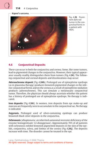 114
4.6 Conjunctival Deposits
These can occur in both the conjunctiva and cornea. Some, like some tumors,
lead to pigmented changes in the conjunctiva. However, their typical appear-
ance usually readily distinguishes them from tumors (Fig. 4.24). The follow-
ing conjunctival and corneal deposits and discolorations may occur:
Adrenochrome deposit (Fig. 4.24h). Prolonged use of epinephrine eyedrops
(as in glaucoma therapy) produces brownish pigmented changes in the infe-
rior conjunctival fornix and on the cornea as a result of epinephrine oxidation
products (adrenochrome). This can simulate a melanocytic conjunctival
tumor. Therefore, the physician should always ascertain whether the patient
has a history of prolonged use of epinephrine eyedrops. No therapy is indi-
cated.
Iron deposits (Fig. 4.24i). In women, iron deposits from eye make-up and
mascara are frequently seen to accumulate in the conjunctival sac. No therapy
is indicated.
Argyrosis. Prolonged used of silver-containing eyedrops can produce
brownish black silver deposits in the conjunctiva.
Ochronosis (alkaptonuria: an inherited autosomal recessive deficiency of the
enzyme homogentisate 1,2-dioxygenase). Approximately 70% of all patients
with ochronosis exhibit brownish pigmented deposits in the skin of the eye-
lids, conjunctiva, sclera, and limbus of the cornea (Fig. 4.24j). The deposits
increase with time. The disorder cannot be treated in the eye.
Kaposi’s sarcoma.
Fig. 4.26 Promi-
nent dark red
tumor in the con-
junctival fornix in
a patient with
AIDS.
4 Conjunctiva
Lang, Ophthalmology © 2000 Thieme
All rights reserved. Usage subject to terms and conditions of license.
 