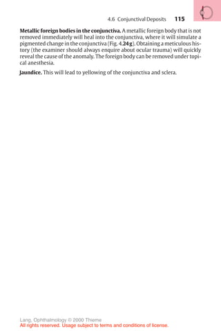 115
Metallic foreign bodies in the conjunctiva. A metallic foreign body that is not
removed immediately will heal into the conjunctiva, where it will simulate a
pigmented change in the conjunctiva (Fig. 4.24g). Obtaining a meticulous his-
tory (the examiner should always enquire about ocular trauma) will quickly
reveal the cause of the anomaly. The foreign body can be removed under topi-
cal anesthesia.
Jaundice. This will lead to yellowing of the conjunctiva and sclera.
4.6 Conjunctival Deposits
Lang, Ophthalmology © 2000 Thieme
All rights reserved. Usage subject to terms and conditions of license.
 