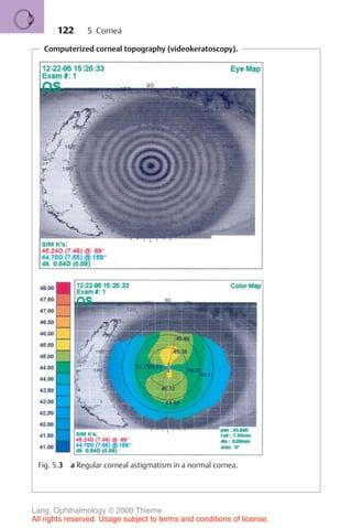 122
Computerized corneal topography (videokeratoscopy).
Fig. 5.3 a Regular corneal astigmatism in a normal cornea.
5 Cornea
Lang, Ophthalmology © 2000 Thieme
All rights reserved. Usage subject to terms and conditions of license.
 