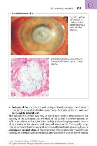 129
Bacterial corneal ulcer.
Fig. 5.7 a Clini-
cal findings in-
clude a central
bacterial corneal
ulcer with hy-
popyon.
b Histologic findings include Gram-
positive rod bacteria in the corneal
stroma.
❖ Prolapse of the iris (the iris will prolapse into the newly created defect)
closing the corneal perforation posteriorly. Adhesion of the iris will pro-
duce a white corneal scar.
This sequence of events can vary in speed and severity. Depending on the
voracity of the pathogens and the state of the patient’s immune system, an
infiltrate can form within a few hours or days and quickly progress to a corneal
ulcer, melting of the stroma, and even a descemetocele. This rapidly prog-
ressing form of infectious corneal ulcer (usually bacterial) is referred to as a
serpiginous corneal ulcer. It penetrates the cornea particularly rapidly and
soon leads to intraocular involvement (the pathogens will be active beyond
5.4 Infectious Keratitis
Lang, Ophthalmology © 2000 Thieme
All rights reserved. Usage subject to terms and conditions of license.
 