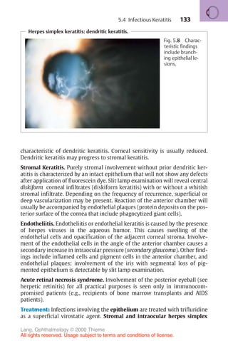 133
characteristic of dendritic keratitis. Corneal sensitivity is usually reduced.
Dendritic keratitis may progress to stromal keratitis.
Stromal Keratitis. Purely stromal involvement without prior dendritic ker-
atitis is characterized by an intact epithelium that will not show any defects
after application of fluorescein dye. Slit lamp examination will reveal central
diskiform corneal infiltrates (diskiform keratitis) with or without a whitish
stromal infiltrate. Depending on the frequency of recurrence, superficial or
deep vascularization may be present. Reaction of the anterior chamber will
usually be accompanied by endothelial plaques (protein deposits on the pos-
terior surface of the cornea that include phagocytized giant cells).
Endotheliitis. Endotheliitis or endothelial keratitis is caused by the presence
of herpes viruses in the aqueous humor. This causes swelling of the
endothelial cells and opacification of the adjacent corneal stroma. Involve-
ment of the endothelial cells in the angle of the anterior chamber causes a
secondary increase in intraocular pressure (secondary glaucoma). Other find-
ings include inflamed cells and pigment cells in the anterior chamber, and
endothelial plaques; involvement of the iris with segmental loss of pig-
mented epithelium is detectable by slit lamp examination.
Acute retinal necrosis syndrome. Involvement of the posterior eyeball (see
herpetic retinitis) for all practical purposes is seen only in immunocom-
promised patients (e.g., recipients of bone marrow transplants and AIDS
patients).
Treatment: Infections involving the epithelium are treated with trifluridine
as a superficial virostatic agent. Stromal and intraocular herpes simplex
Herpes simplex keratitis: dendritic keratitis.
Fig. 5.8 Charac-
teristic findings
include branch-
ing epithelial le-
sions.
5.4 Infectious Keratitis
Lang, Ophthalmology © 2000 Thieme
All rights reserved. Usage subject to terms and conditions of license.
 