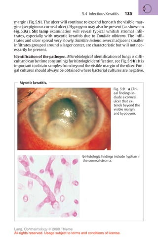 135
margin (Fig. 5.9). The ulcer will continue to expand beneath the visible mar-
gins (serpiginous corneal ulcer). Hypopyon may also be present (as shown in
Fig. 5.9a). Slit lamp examination will reveal typical whitish stromal infil-
trates, especially with mycotic keratitis due to Candida albicans. The infil-
trates and ulcer spread very slowly. Satellite lesions, several adjacent smaller
infiltrates grouped around a larger center, are characteristic but will not nec-
essarily be present.
Identification of the pathogen. Microbiological identification of fungi is diffi-
cultandcanbetimeconsuming(forhistologicidentification,seeFig. 5.9b).Itis
important to obtain samples from beyond the visible margin of the ulcer. Fun-
gal cultures should always be obtained where bacterial cultures are negative.
Mycotic keratitis.
Fig. 5.9 a Clini-
cal findings in-
clude a corneal
ulcer that ex-
tends beyond the
visible margin
and hypopyon.
b Histologic findings include hyphae in
the corneal stroma.
5.4 Infectious Keratitis
Lang, Ophthalmology © 2000 Thieme
All rights reserved. Usage subject to terms and conditions of license.
 