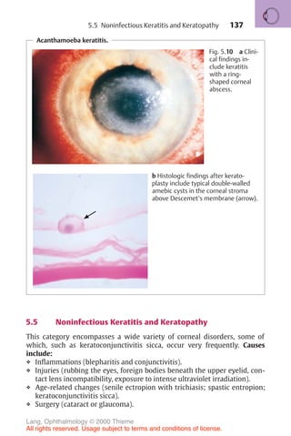 137
Acanthamoeba keratitis.
Fig. 5.10 a Clini-
cal findings in-
clude keratitis
with a ring-
shaped corneal
abscess.
b Histologic findings after kerato-
plasty include typical double-walled
amebic cysts in the corneal stroma
above Descemet’s membrane (arrow).
5.5 Noninfectious Keratitis and Keratopathy
This category encompasses a wide variety of corneal disorders, some of
which, such as keratoconjunctivitis sicca, occur very frequently. Causes
include:
❖ Inflammations (blepharitis and conjunctivitis).
❖ Injuries (rubbing the eyes, foreign bodies beneath the upper eyelid, con-
tact lens incompatibility, exposure to intense ultraviolet irradiation).
❖ Age-related changes (senile ectropion with trichiasis; spastic entropion;
keratoconjunctivitis sicca).
❖ Surgery (cataract or glaucoma).
5.5 Noninfectious Keratitis and Keratopathy
Lang, Ophthalmology © 2000 Thieme
All rights reserved. Usage subject to terms and conditions of license.
 
